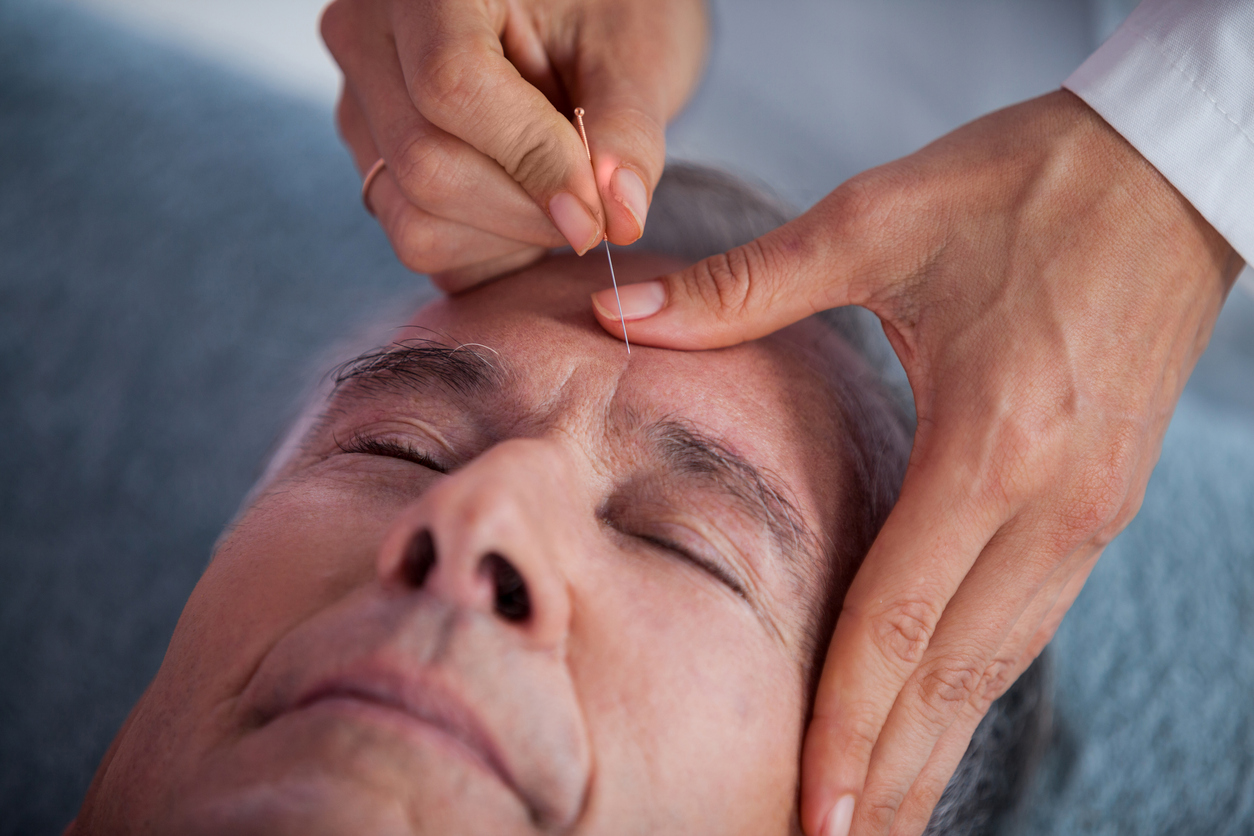 Acupuncture