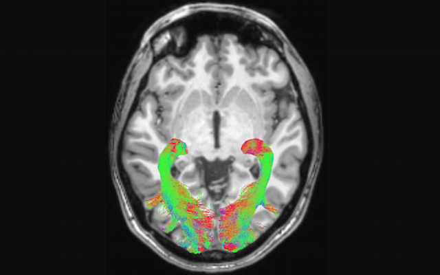 Visual system changes could signal Parkinson’s disease