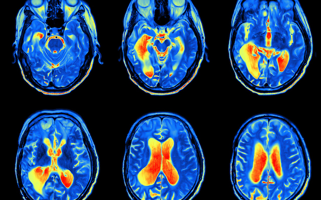 Parkinson's in the news: December