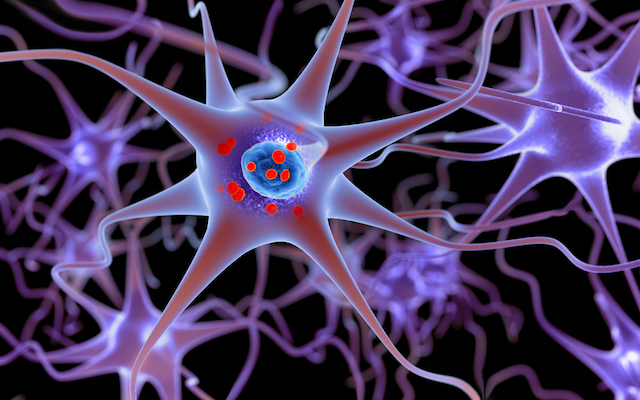 Parkinson's disease. 3D illustration showing neurons containing Lewy bodies small red spheres which are deposits of proteins (alpha-synuclein) accumulated in the brain cells.