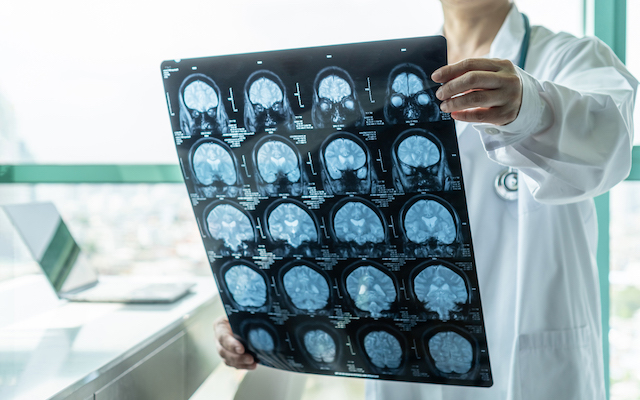 Clinician holds up a sheet of brain imaging scans.