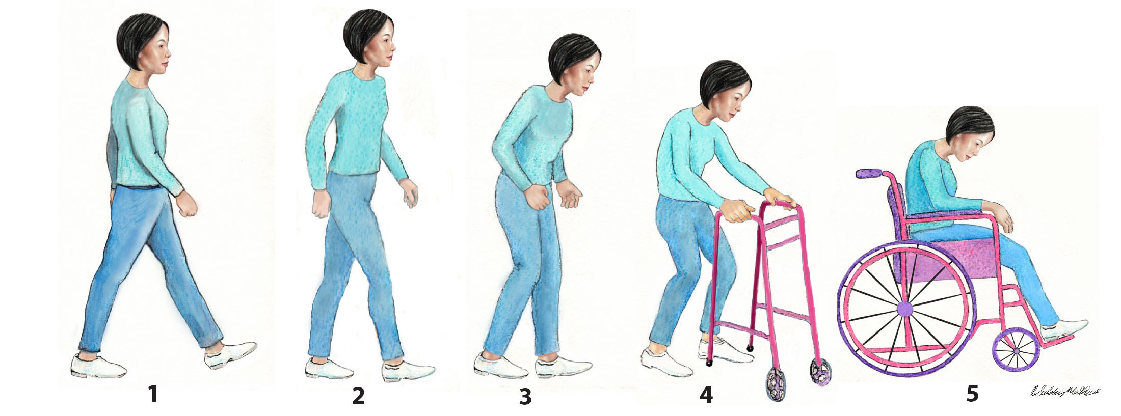 The Five Stages of Parkinson's