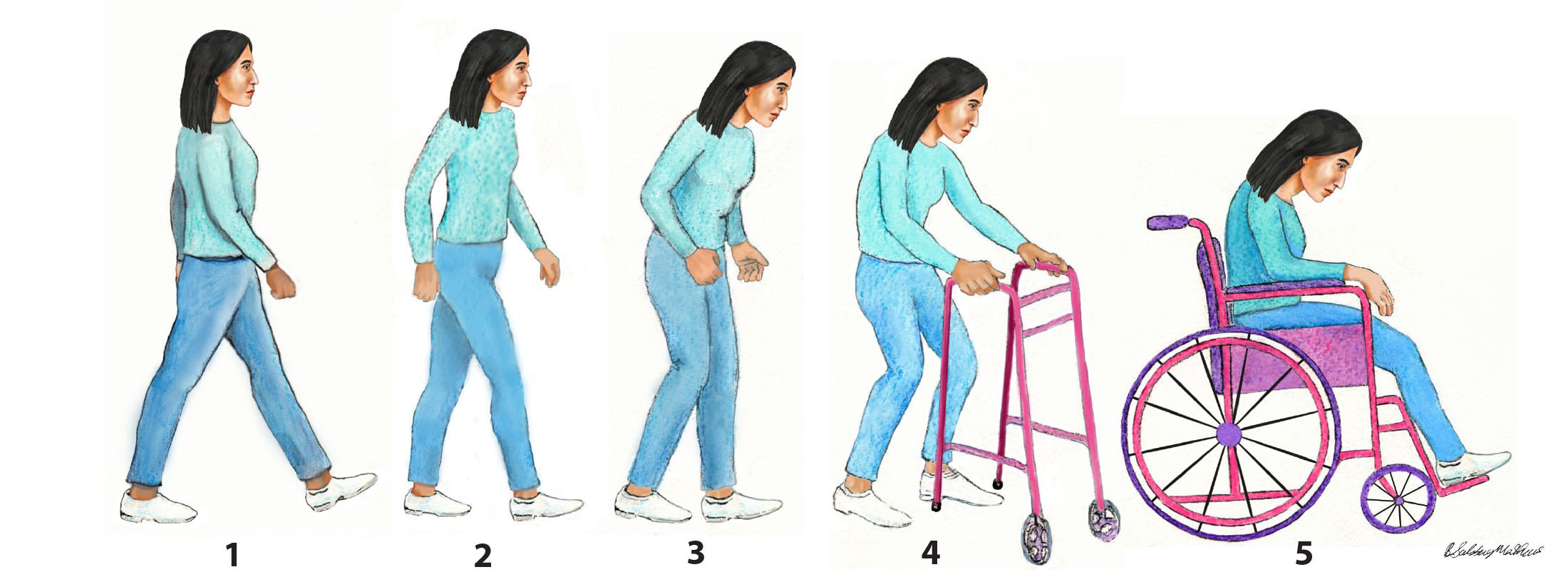 The Five Stages of Parkinson's