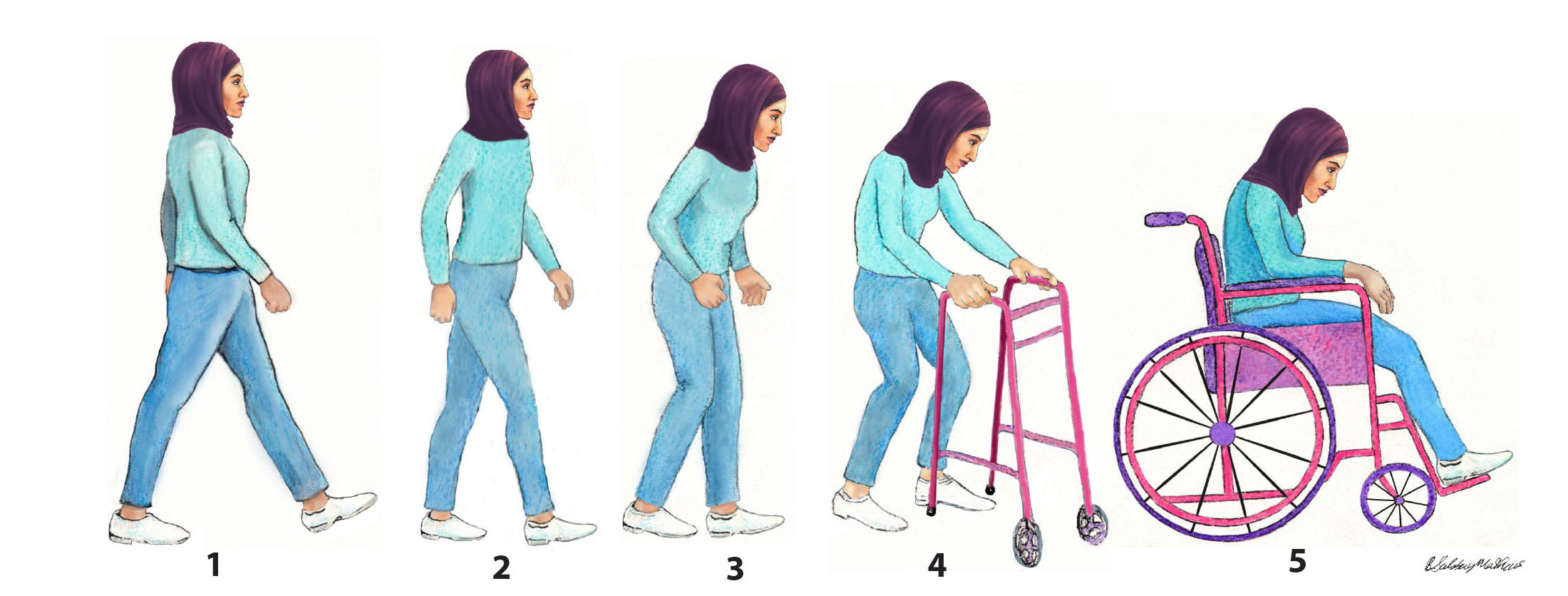 The Five Stages of Parkinson's