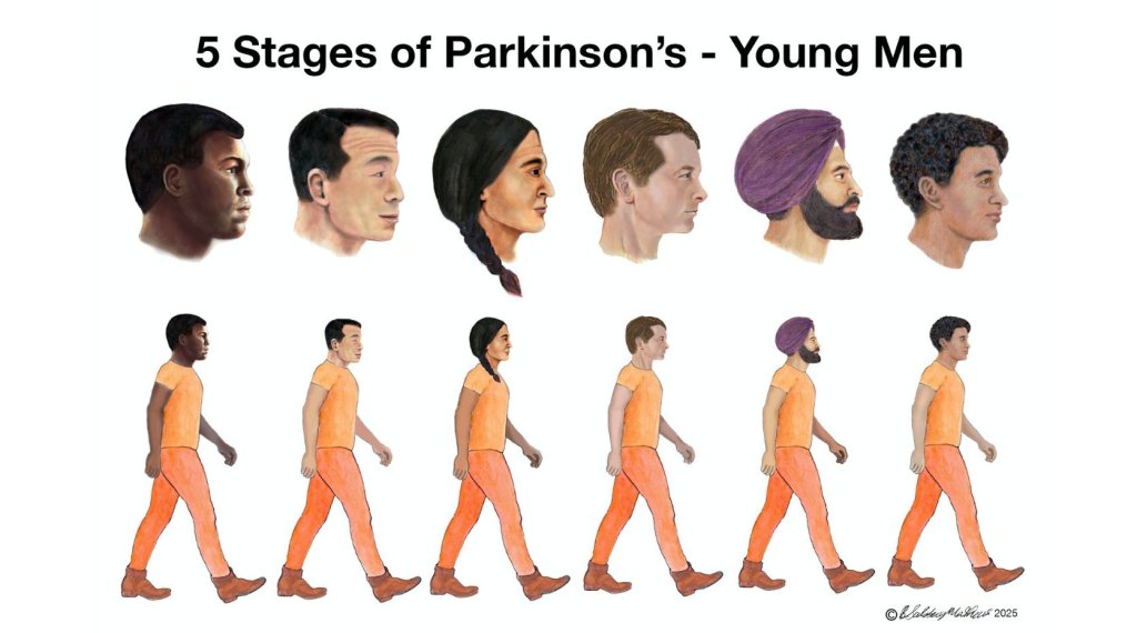 Canadian artist Barbara Salsberg Mathews creates Parkinson's illustrations for International Men's Day 2025