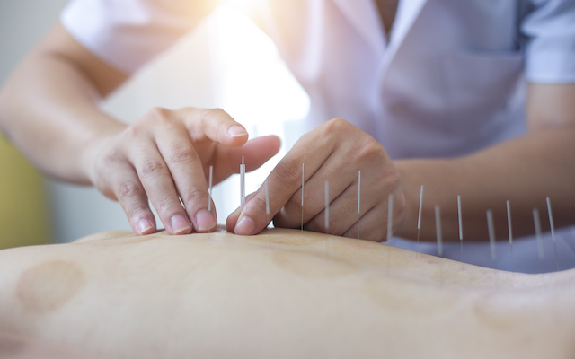 Person receiving acupuncture treatment