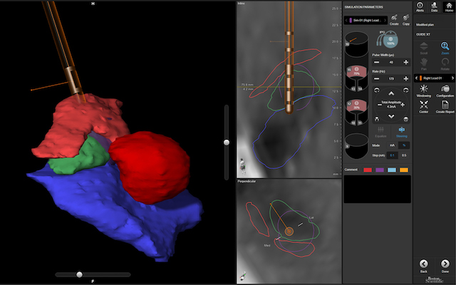A visualisation software showing patient-specific anatomy.
